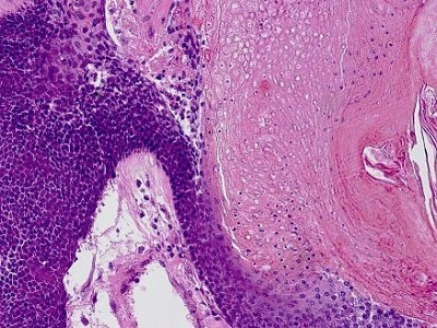<span>Pilomatrixoma – po lewej drobne ciemne komórki nowotworowej macierzy wosa, po prawej ich duchy; LWozniak&KWZielinski, CC BY-SA 3.0, </span>https://commons.wikimedia.org/w/index.php?curid=11990417