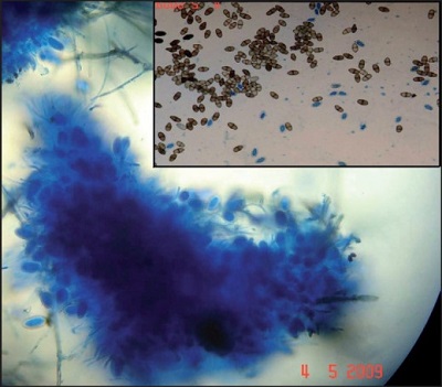 <span>Lasiodiplodia theobromae wydobyty z zatok trzydziestoletniej pacjentki; </span>https://www.ncbi.nlm.nih.gov/pubmed/20404468