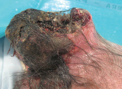 <span>Cierpica na depresj pacjentka dotara z guzem owosionej skóry gowy do szpitala dopiero po omiu latach; </span>https://www.ncbi.nlm.nih.gov/pmc/articles/PMC5505856/