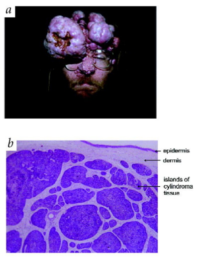 Cylindromatoza rodzina; na górze obraz makro-, na dole- mikroskopowy; http://www.nature.com/ng/journal/v25/n2/full/ng0600_160.html