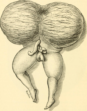 Zjawisko rzadkie, aczkolwiek od dawna medycynie znane; “The science and art of midwifery” (1897), domena publiczna, https://www.flickr.com/photos/internetarchivebookimages/14576785638/