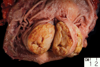 Podluzówkowy GIST odka na przekroju; http://www.archivesofpathology.org/doi/full/10.5858/arpa.2011-0022-RA