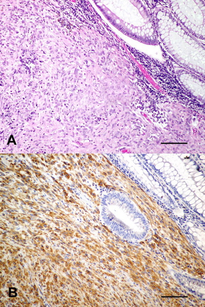 A to te GIST, ale psi; podobnie jak ludzki zwizany jest z mutacjami w genie c-kit i mona go zdiagnozowa przy pomocy przeciwcia przeciwko CD117 (na dole); CC-BY, http://www.ncbi.nlm.nih.gov/pmc/articles/PMC2970610/