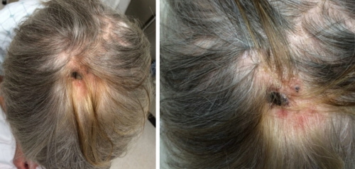 Pośród siwiejących włosów pacjentki pojawiło się pasmo wybarwione złocistobrązowo; w centrum widoczny rozwinięty w tym miejscu owrzodziały czerniak; CC BY-NC-ND 4.0; https://escholarship.org/uc/item/9gc61299#page-1