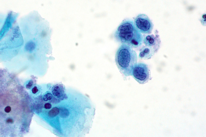 Po lewej due komórki zdrowego nabonka paskiego, po prawej grupka nabonków zmienionych nowotworowo, o wielkich, nieregularnych jdrach komórkowych i mae iloci cytoplazmy; to zmiany do zaawansowane ju, ale najprawdopodobniej ograniczone jeszcze do nabonka – potwierdz to pobrane z szyjki wycinki; Ed Uthman, CC BY 2.0, https://www.flickr.com/photos/euthman/6032536156/