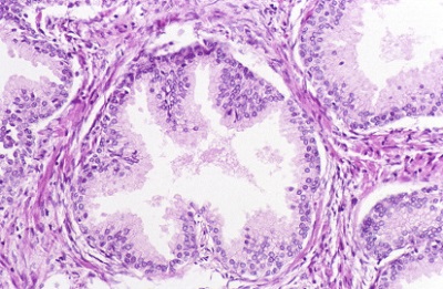 <span>Nabonek rozrastajcy si i wpuklajcy palczasto do wiata gruczou; University of Alabama at Birmingham Department of Pathology, </span>http://peir.path.uab.edu/library/picture.php?/10496