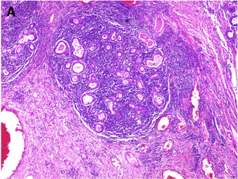 <span>Te same gruczoy podluzówkowe masywnie nacieczone zapalnie, wysane nabonkiem typu przewodowego; K. Garman, </span>https://medicine.duke.edu/divisions/gastroenterology/research/basic-and-translational-research/garman-lab