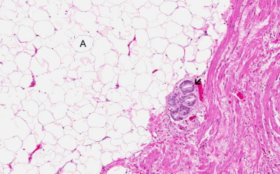 Drobne ognisko raka prostaty (strzaka) wnika w okoosterczow tkank tuszczow (A); University of Oklahoma Health Sciences Center; http://moon.ouhsc.edu/kfung/JTY1/OUMC/Content/OUMC-G-001-Discuss.htm