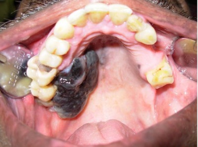 Pierwotny czerniak jamy ustnej; CC-BY; https://www.ncbi.nlm.nih.gov/pmc/articles/PMC3414006/