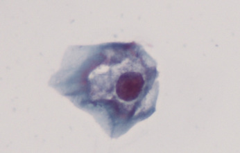 Komórka nabonkowa z cechami infekcji HPV – nieregularnych ksztatów jdro z wyranym przejanieniem wokó; Manuel Medina, domena publiczna