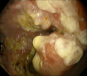 Z rzadka HCG mog wydziela take i guzy zlokalizowane poza narzdami pciowymi, w tym akurat przypadku – w odku; https://www.ncbi.nlm.nih.gov/pmc/articles/PMC2697469/