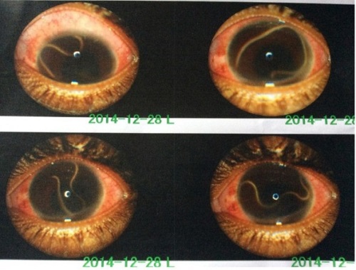 Loa loa w komorze przedniej oka pacjentki; CC-BY, https://www.ncbi.nlm.nih.gov/pmc/articles/PMC4824396/ 