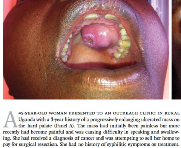 <span>Kilak podniebienia pierwotnie wzity za raka – by zdoby rodki na leczenie pacjentka pacjentka próbowaa sprzeda dom; </span>https://www.nejm.org/doi/full/10.1056/NEJMicm1313142