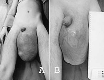 <span>Prawie piciokilogramowy mieszany nowotwór germinalny jdra u dwudziestojednoletniego pacjenta; </span>https://www.ncbi.nlm.nih.gov/pubmed/14755145