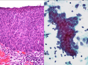 Duego stopnia neoplazja ródnabonkowa, HSIL, CIN3, czyli de facto rak, który jeszcze nie nacieka; wycinek tkankowy versus cytologia ginekologiczna; lunar caustic, https://www.flickr.com/photos/lunarcaustic/2967399164/