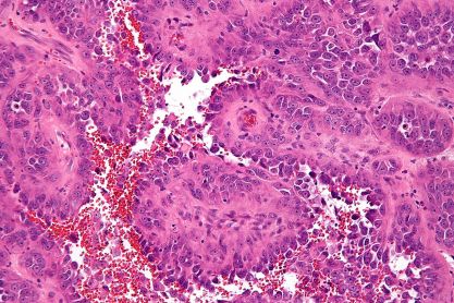 Naczyniakomisak wywodzcy si z komórek tworzcych ródbonek naczy krwiononych; CC BY-SA 3.0, Nephron, https://en.wikipedia.org/wiki/Angiosarcoma