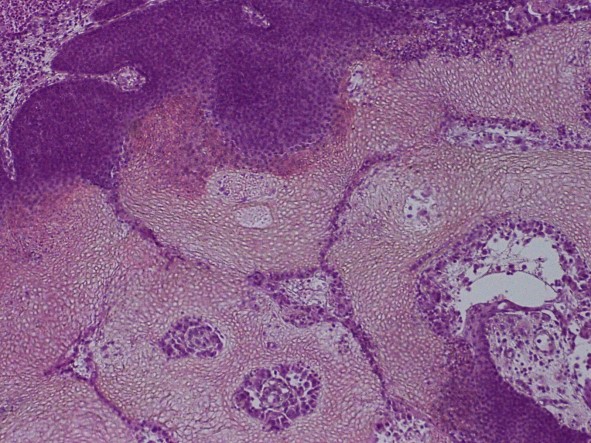<span>Pilomatrixoma – drobne ciemnoniebieskie komórki orz puste cienie komórkowe; LWozniak&KWZielinski, CC BY-SA 3.0, </span>https://commons.wikimedia.org/w/index.php?curid=11990331