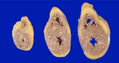 Amelanotyczne przerzuty czerniaka w sercu; https://www.sciencedirect.com/science/article/abs/pii/S1878540918300987