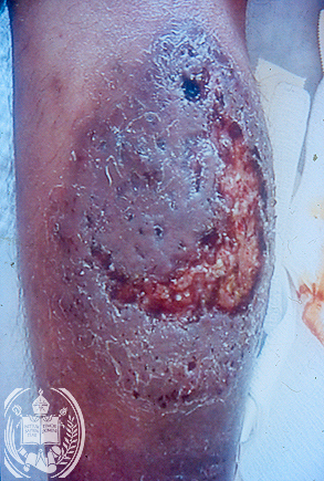 Prototekoza skórna u czowieka; Facultad de Medicina, Universidad de Los Andes, Venezuela; http://www.saber.ula.ve/tropical/contenido/capitulo15/capitulo65/contenidocapitulo-en.html