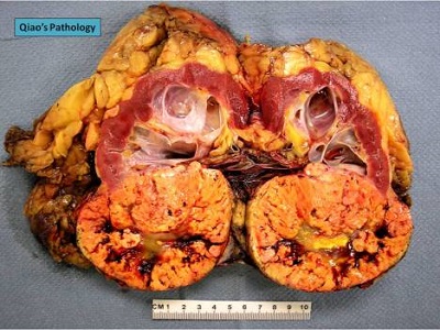 <span>Przekrojona nerka z intensywnie ótym rakiem jasnokomórkowym u dou; Qiao’s Pathology, </span>https://www.flickr.com/photos/jian-hua_qiao_md/8448173383/
