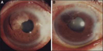 Przerzutowy rak drobnokomórkowy puca – radioterapia daa tu bardzo dobre efekty; http://www.sciencedirect.com/science/article/pii/S1556086415307188