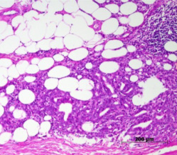 Rak prostaty nacieka tkank tuszczow; https://www.rcpa.edu.au/Library/Practising-Pathology/ICCR/docs/ICCR_Prostate_RP_EPE