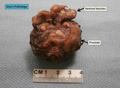 Prostata z pcherzykami nasiennymi; Jian-Hua Qiao; https://www.flickr.com/photos/jian-hua_qiao_md/8519225312