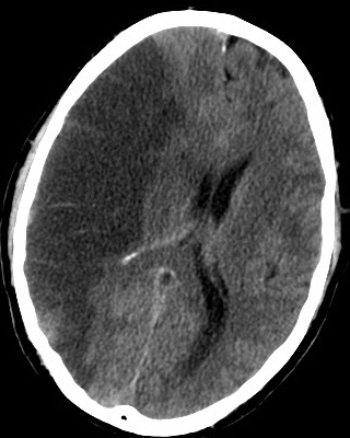 Obraz TK prawostronnego udaru niedokrwiennego mózgu (ciemniejsza plama po lewej stronie zdjcia); Lucien Monfils; Wikipedia; CC BY-SA 3.0