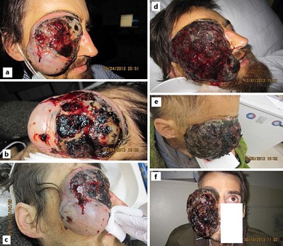 <span>Olbrzymi czerniak oczodou u bezdomnego pacjenta; zdjcia z kolejnych doranych hospitalizacji; </span>https://www.ncbi.nlm.nih.gov/pmc/articles/PMC5437443/
