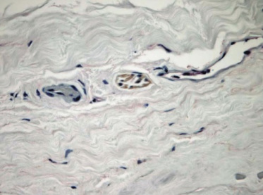 Opona twarda wokó nerwu wzrokowego; po lewej drobne naczynie ttnicze, po prawej – ylne, porodku wybarwione podoplanin (D2-40) naczynie limfatyczne; https://www.ncbi.nlm.nih.gov/pubmed/15625904