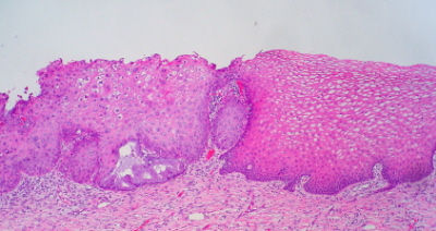 Nabonek paski tarczy – po prawej zdrowy, po lewej zmieniony wskutek infekcji HPV, na razie w niewielkim stopniu; Ed Uthman, CC BY 2.0; https://www.flickr.com/photos/euthman/2796932803/