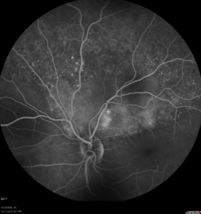 Obraz angiograficzny (angiografia fluoresceinowa) naczyniówki usianej iskierkami i przejanieniami przerzutów raka sutka powodujcych czciowe odwarstwienie siatkówki; https://www.hindawi.com/journals/bmri/2015/574086/