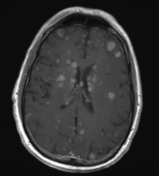 Przerzuty czerniaka w mózgu pacjenta, którego pierwotna zmiana zdya po pobraniu wycinka do diagnozy samoistnie znikn, pozostawiajc jedynie “czyst” skór i przerzuty; https://www.ncbi.nlm.nih.gov/pubmed/27981212