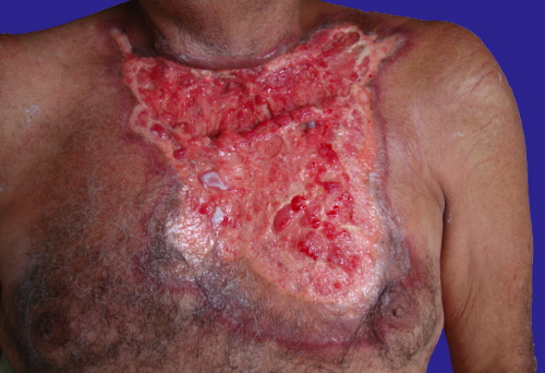 Rak ojowy; CC BY-NC-ND 4.0; https://escholarship.org/uc/item/1rm5p048?query=carcinoma