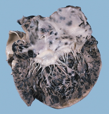Serce na przekroju – czarne obszary to przerzuty czerniaka; PEIR Digital Library (Pathology image database), AFIP; domena publiczna