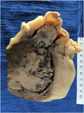 Przerzut raka szyjki macicy zajmuje niemal cae wiato prawej komory serca, wrastajc czciowo do pnia pucnego; CC BY-NC-ND 4.0, http://www.sciencedirect.com/science/article/pii/S2214330016300840