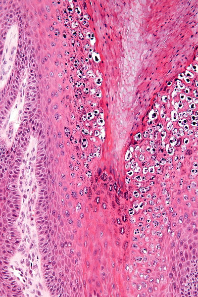 Brodawka wirusowa – wida ciemniejsze ziarnistoci typowe dla zmian wywoanych przez HPV; Nephron, Wikipedia; CC BY-SA 3.0