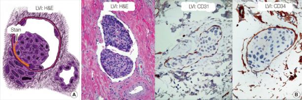 Komórki raka piersi w wietle naczy limfatycznych (LVI, lymphovascular invasion) – tak rozpoczyna si ich wdrówka po ciele; zdjcia po prawej podbarwione przy pomocy przeciwcia przeciwko biakom ródbonka naczy; NG Zaorsky, https://www.ncbi.nlm.nih.gov/pmc/articles/PMC3542859/, CC BY-NC 3.0