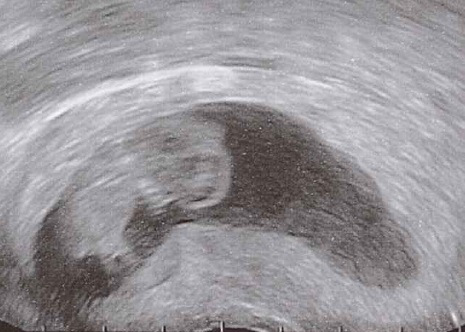 USG wykonane podczas medycznej aborcji w 10 tygodniu ciąży na etapie opróżniania się jamy macicy; po lewej stronie z dołu rozwierająca się szyjka macicy; płód dłg. 33mm; Mikael Häggström; domena publiczna