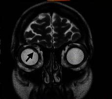 Przerzut raka grasicy do naczyniówki, MRI; https://www.ncbi.nlm.nih.gov/pmc/articles/PMC4682268/